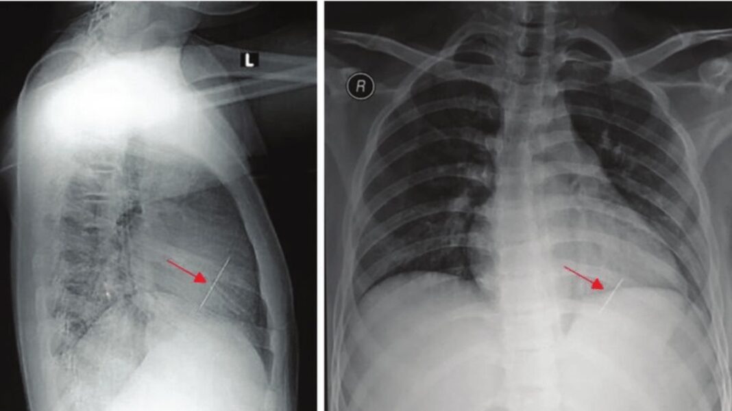 Needle in Lungs